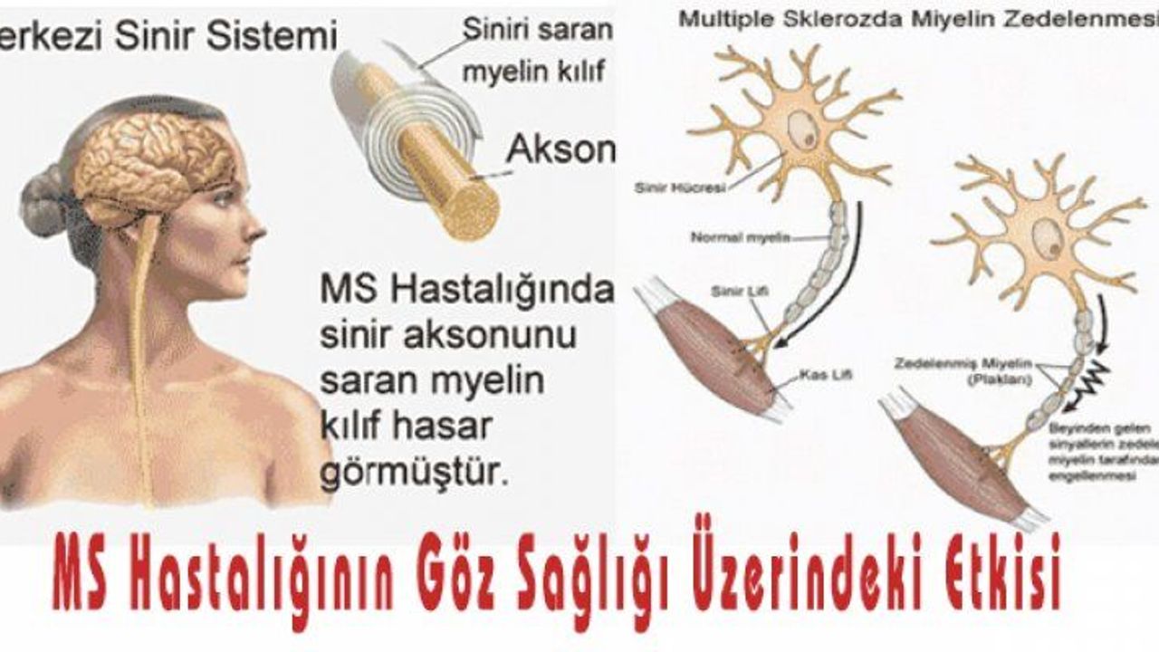 DİKKAT! MS Hastalığı Önce Gözlere Vuruyor