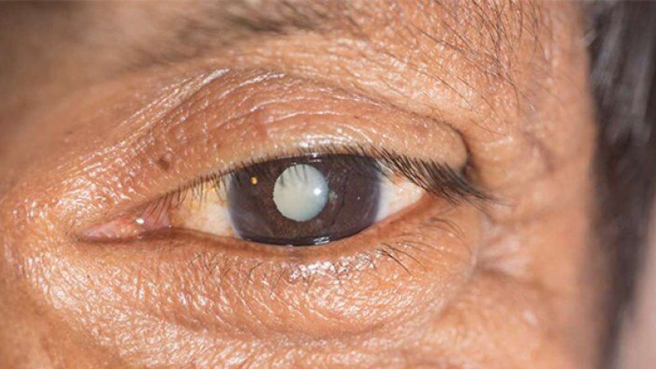 Katarakt İçin Göz Damlası Tedavisi Geliştirildi