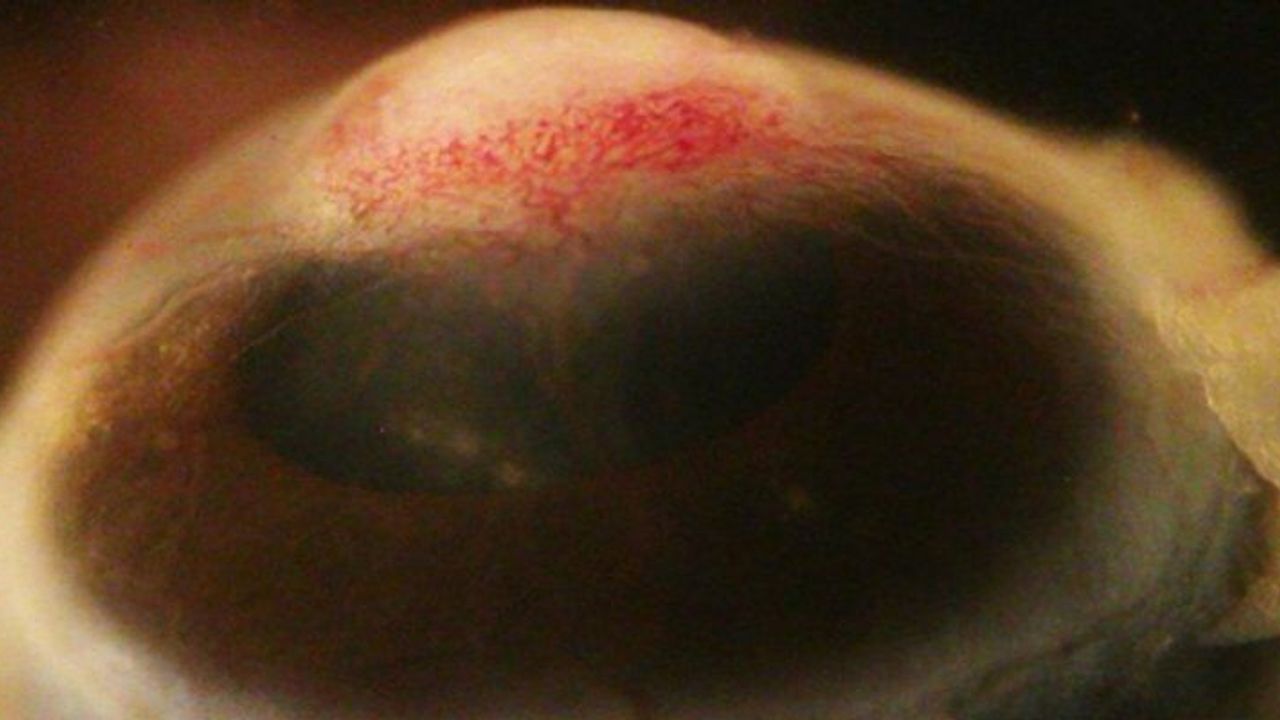 Kronik İnflamasyon ile Göz Hücrelerinin Deriye Dönüşümü