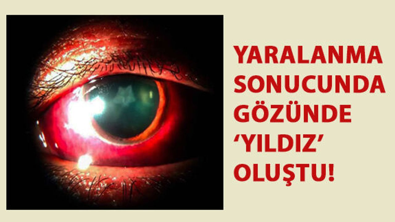 Travmatik Yaralanma Sonucunda Gözünde 'Yıldız' Oluştu!
