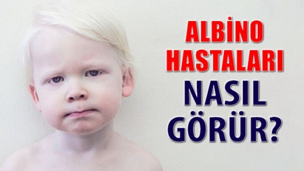 Beyaz Melek Albino Hastaları Ve Görme Kusurları