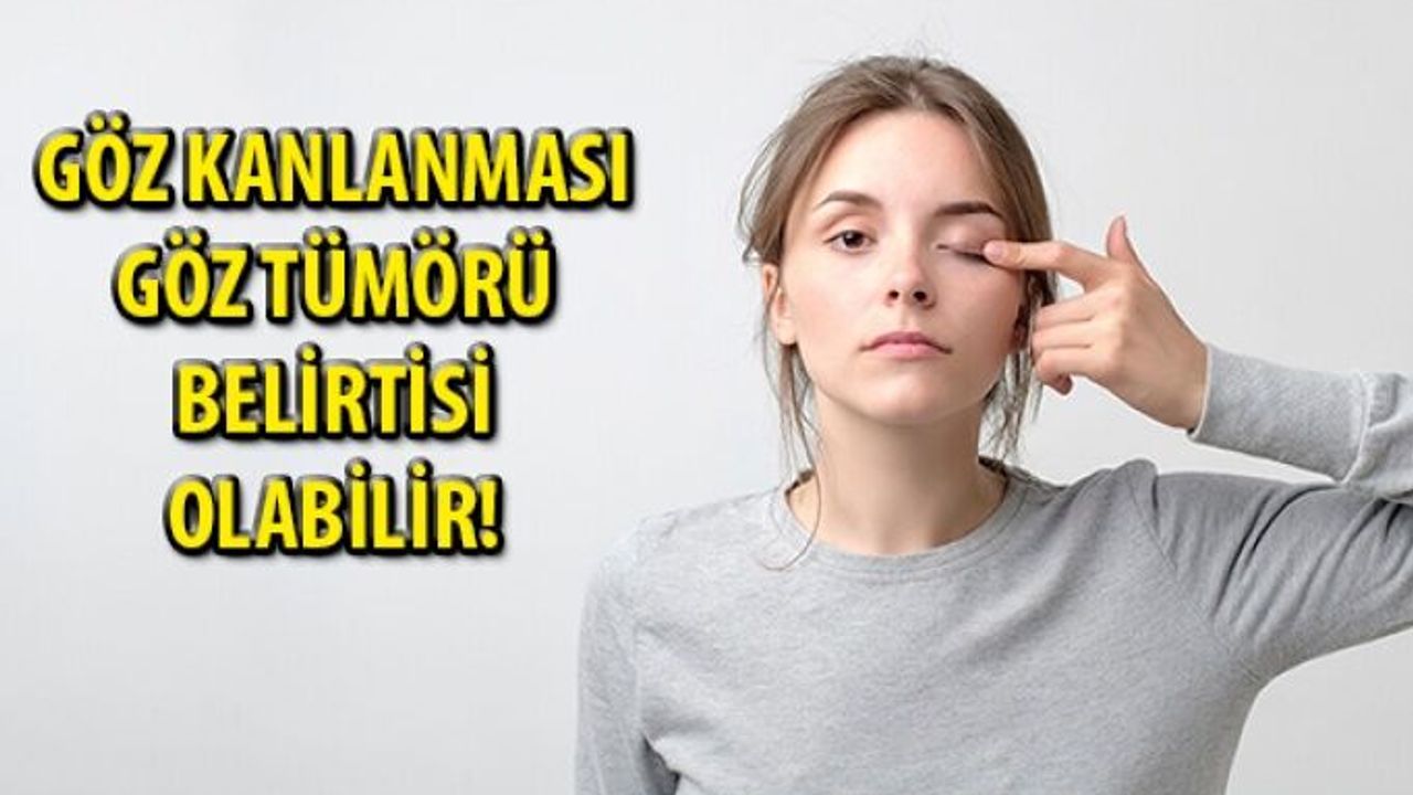 Göz Kanlanmasına Dikkat! Siz de Yaşıyorsanız...