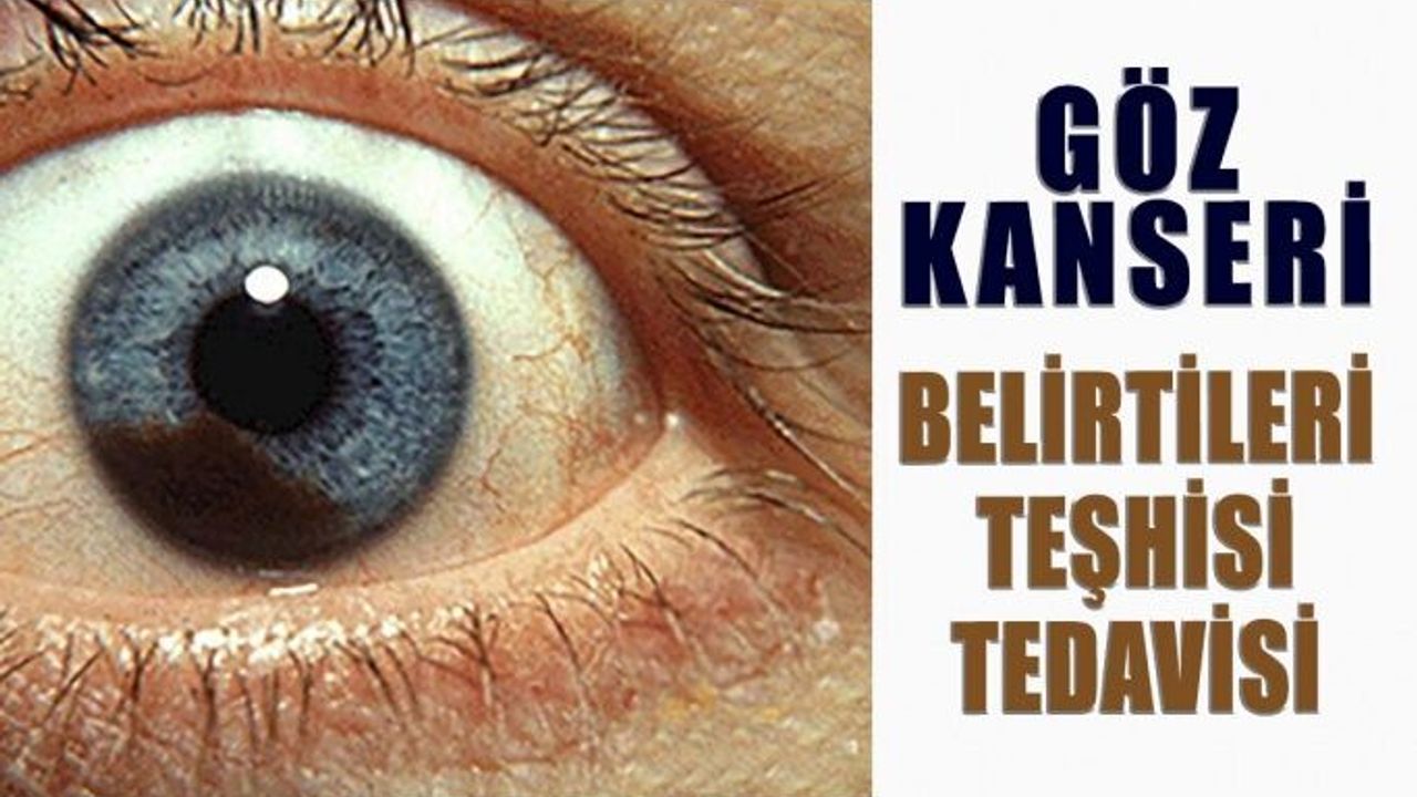 Göz Melanom Belirtileri Nedir, Nasıl Tedavi Edilir?