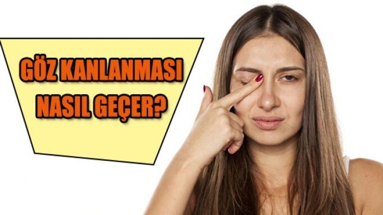 Göz Kanlanması Neden Olur? Nasıl Geçer?