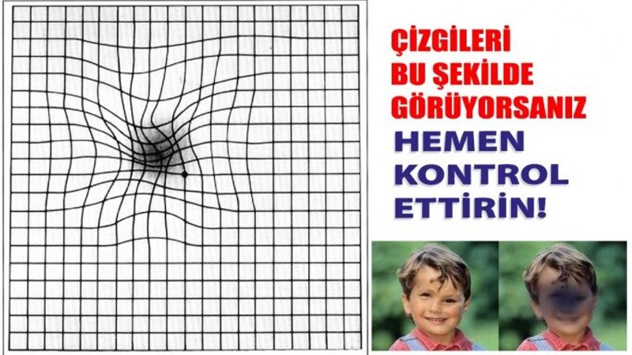 Çizgileri Eğik Görüyorsanız Sizde De Sarı Nokta Olabilir