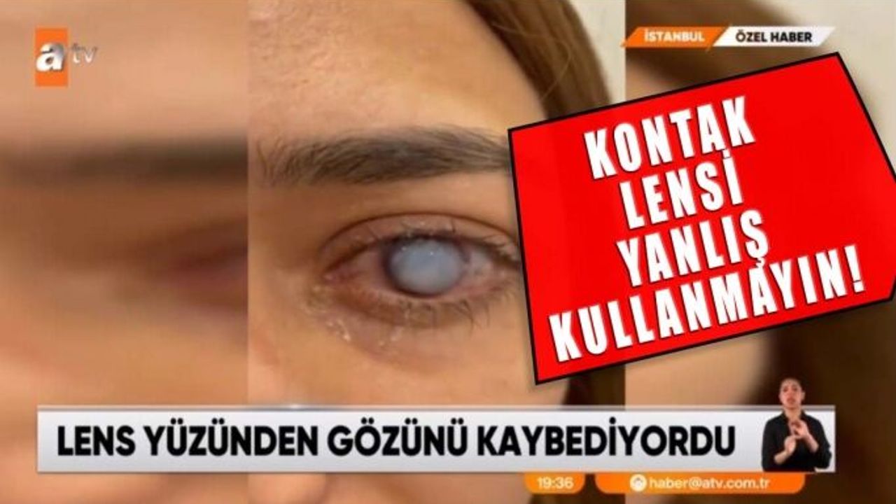 Kontak Lensin Yanlış Kullanımı Tehlikeli Sonuçlara Sebep Oluyor