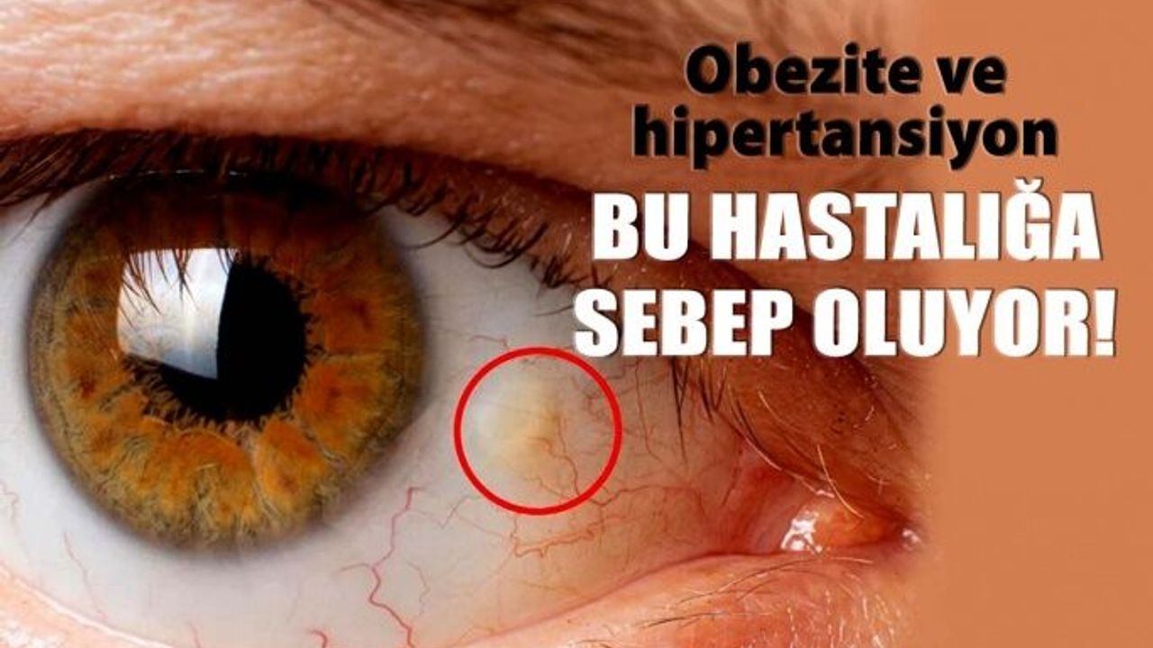 Obezite Ve Hipertansiyon ‘Sarı Nokta’ Sebebi
