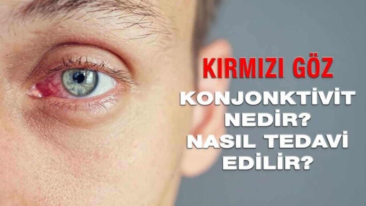 Kırmızı Göz Hastalığı Konjonktivit Nedir, Nasıl Tedavi Edilir?
