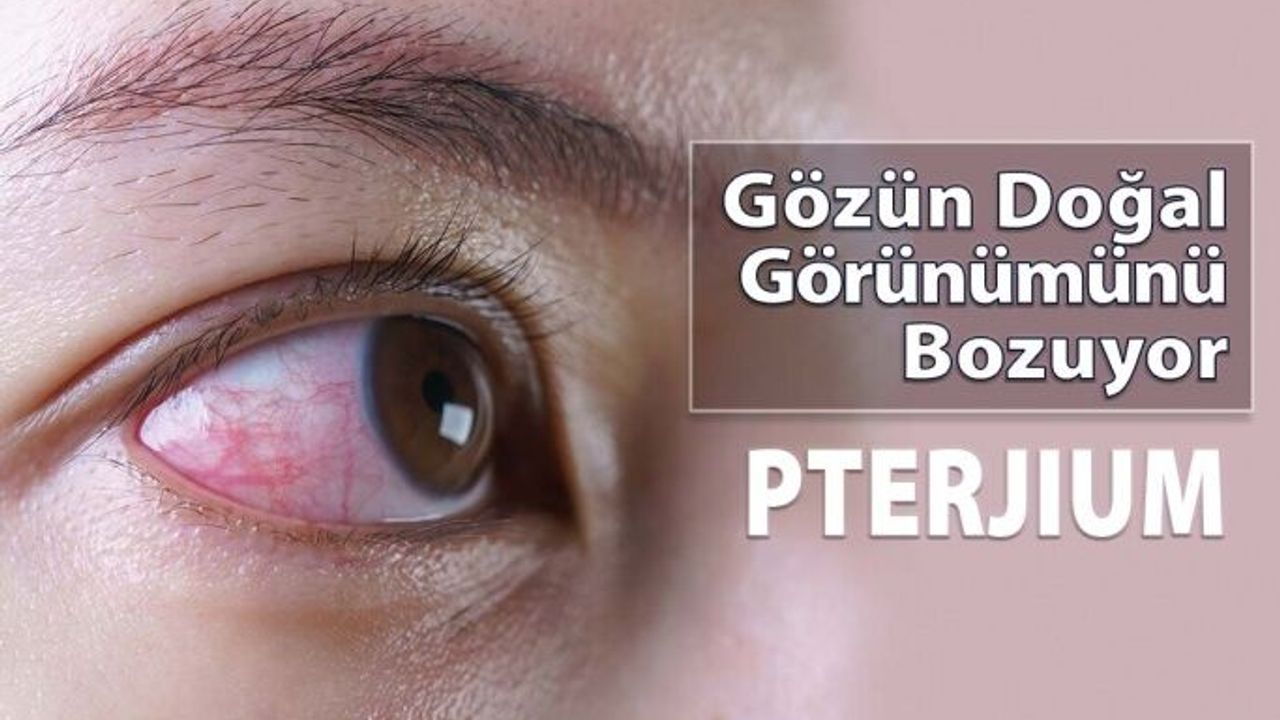 Gözün Doğal Görünümünü Bozan Hastalık: Pterjium