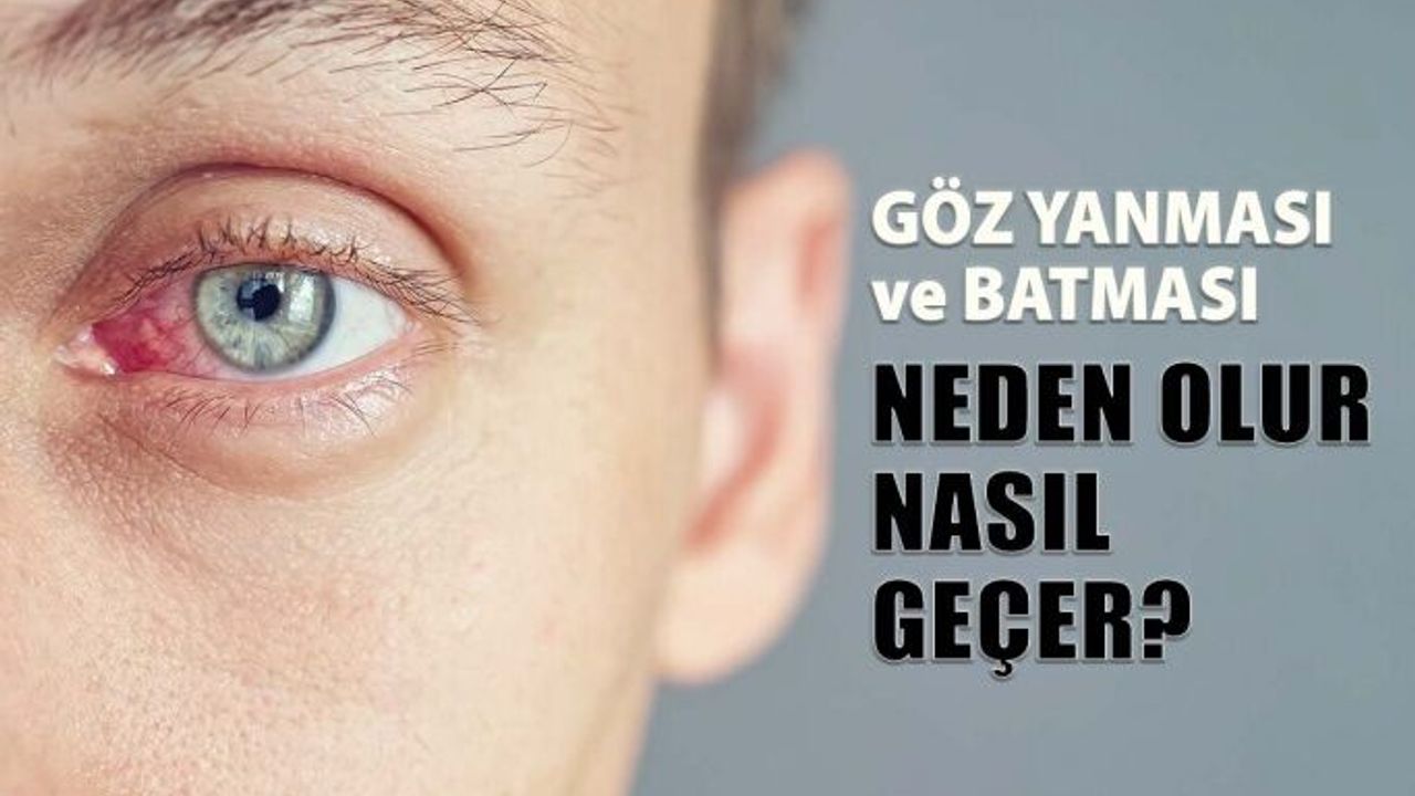 Göz Batması ve Yanması Neden Olur Nasıl Geçer?