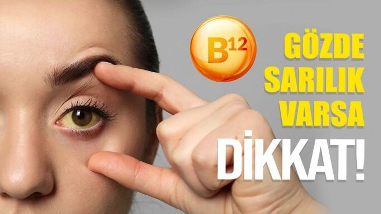 Gözünüzün Beyazı Sarı Renge Dönüştüyse Dikkat!