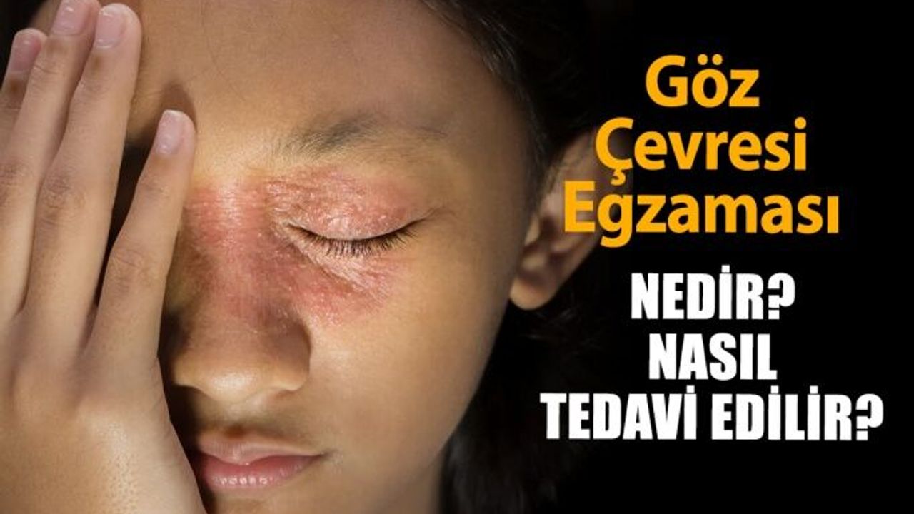 Göz Çevresi Egzaması Nedir? Nasıl Tedavi Edilir?