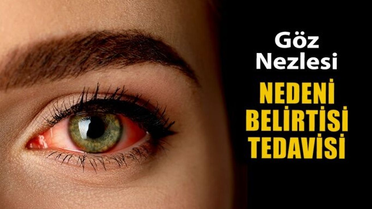 Göz Nezlesi Nedir? Nedenleri, Belirtisi ve Tedavisi