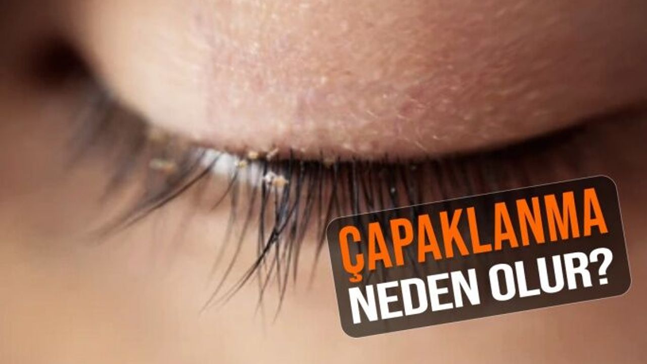 Gözlerde Çapaklanma Neden Olur? Tedavisi Nasıldır?