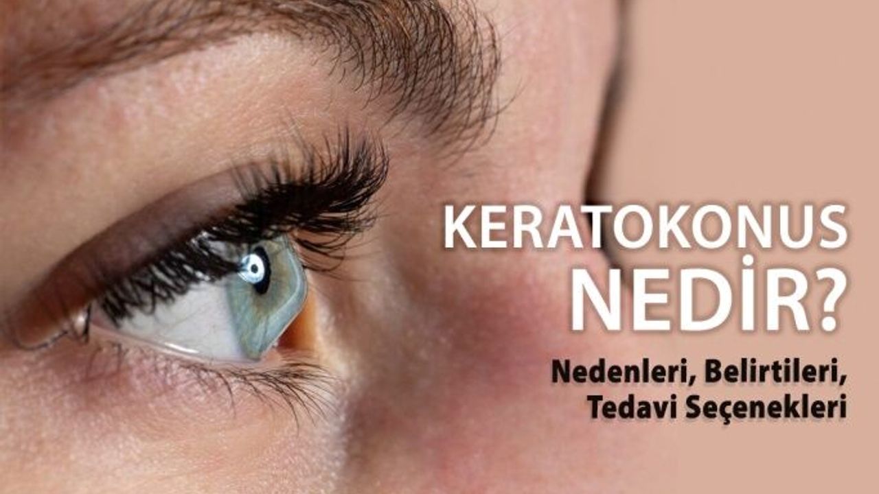 Keratokonus Nedir? Nedenleri, Belirtileri, Tedavi Seçenekleri