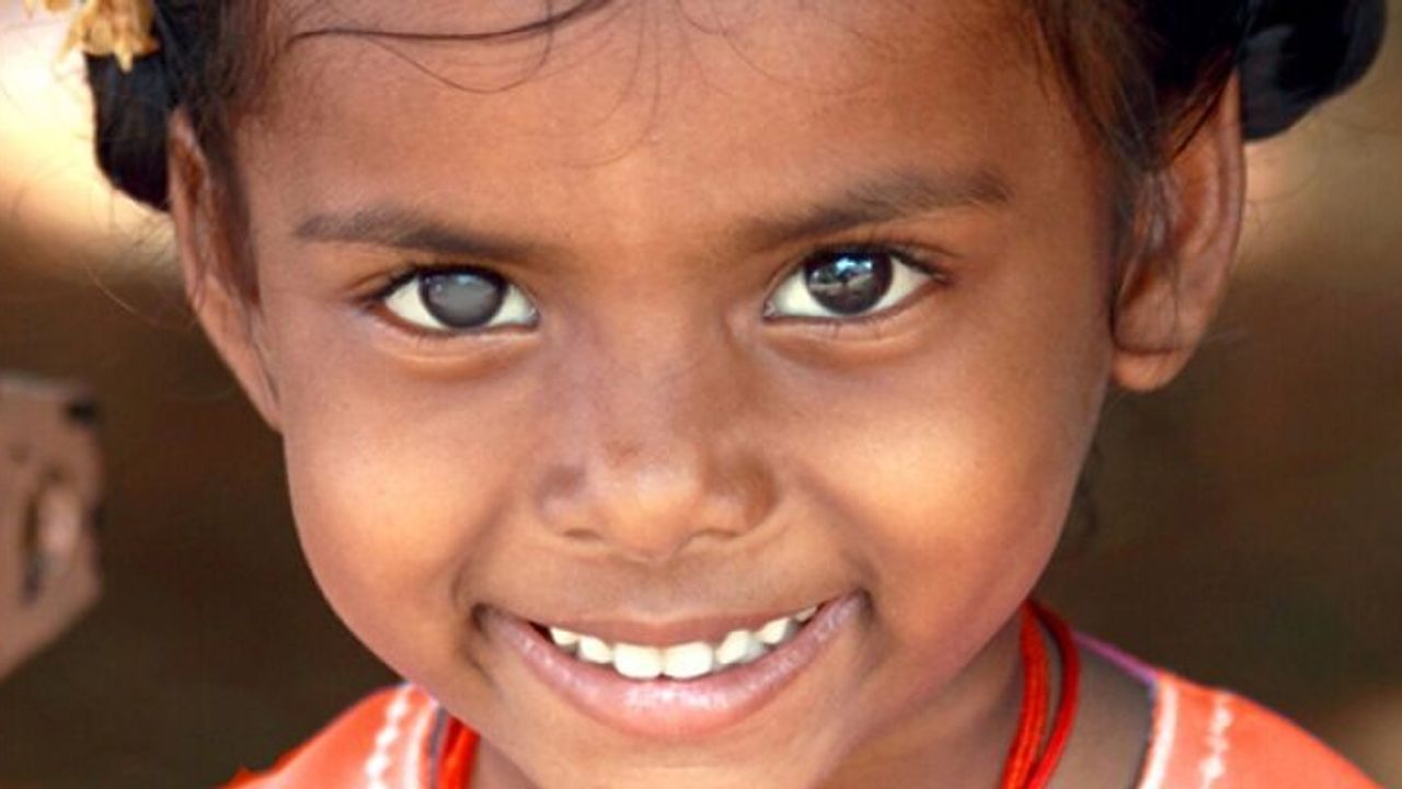 ABD'de Bilim Adamları Kataraktla Bağlantılı 2 Geni Belirledi!