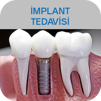 DİŞ İMPLANT