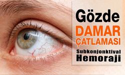 Gözde Kanlanma, Gözde Damar Çatlaması Neden Olur?