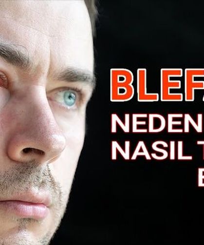 Blefarit Neden Olur Nasıl Tedavi Edilir?
