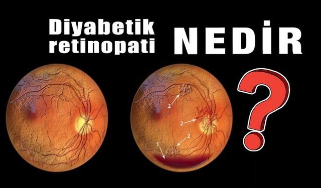 Diyabetik Retinopati Nedir?