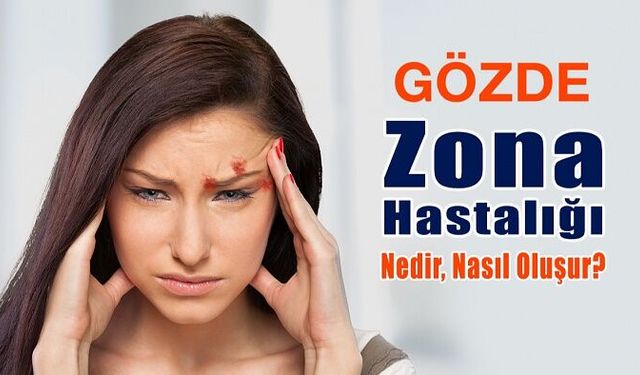Gözde Zona Hastalığı: Nedir, Nasıl Oluşur?