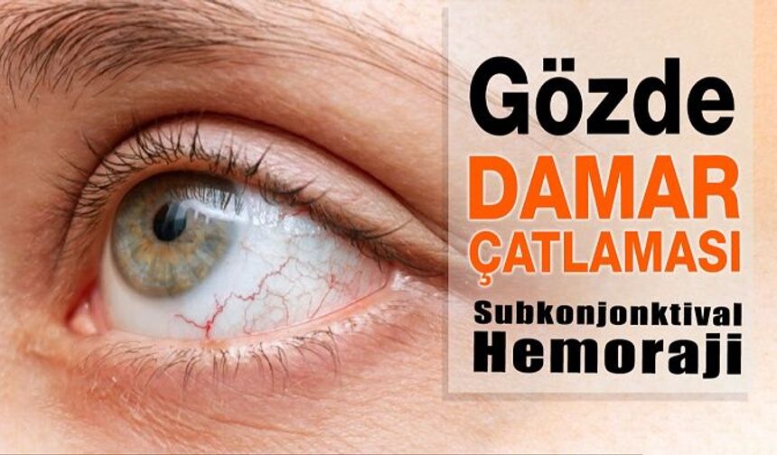 Gözde Kanlanma, Gözde Damar Çatlaması Neden Olur?